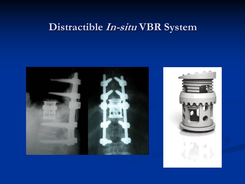 Distractible In-situ VBR System